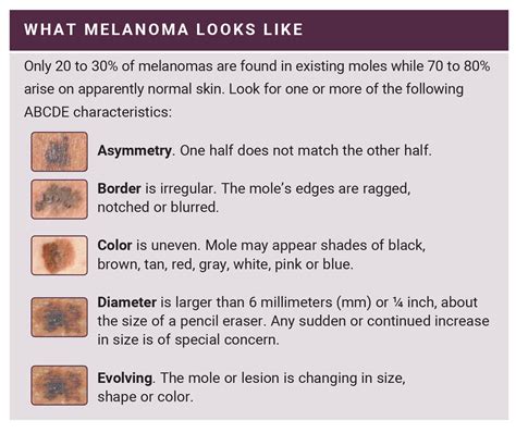 How To Diagnose Melanoma - Methodchief7