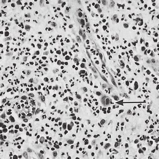 Sections from granulation tissue of a colonic mucosal ulcer containing ...