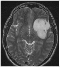 Astrocytoma Sydney | Brain Cancers Sydney | Brain Surgeon Sydney, Australia