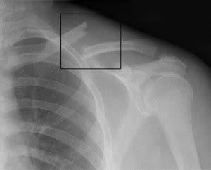 clavicle fracture radiology – Medchrome