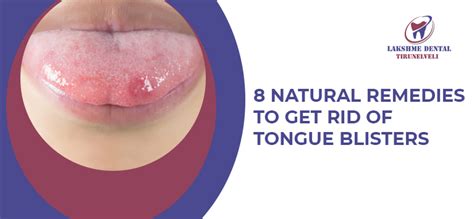 How To Get Rid Of Tongue Blisters - Staybite11