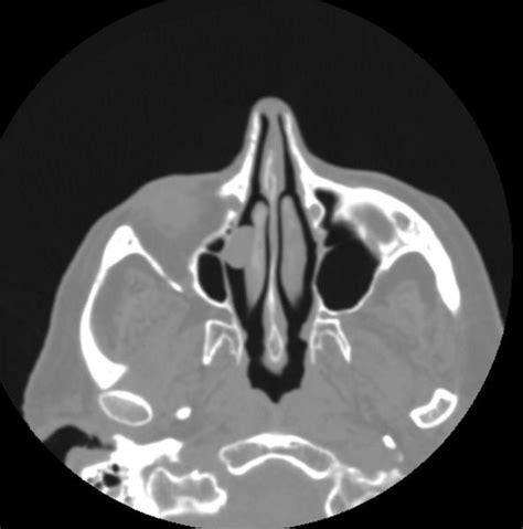 Nasal polyp - wikidoc