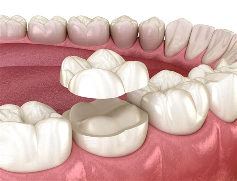 Porcelain Onlays - California Dental Care