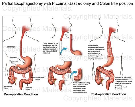 Pin on cancer, esophageal