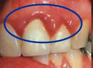 Gum Infection: What It Is And How To Treat It | OraMD