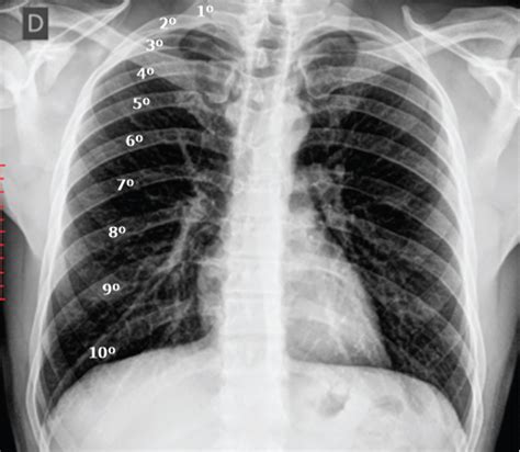 Evaluation of Chest X-Ray Quality Parameters