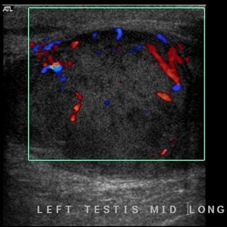 Testicular seminoma | Radiology Reference Article | Radiopaedia.org