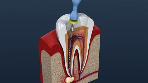 Do You Always Need a Crown After Root Canal? - Smile Angels of Beverly Hills