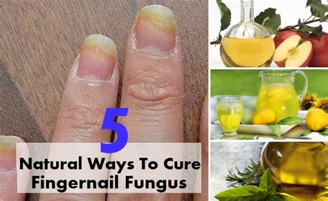 Top 5 Natural Ways To Cure Fingernail Fungus | Find Home Remedy & Supplements