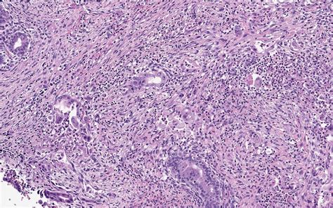 Pathology Outlines - Gastric type adenocarcinoma