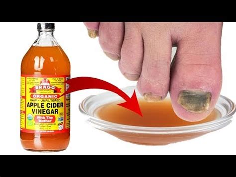 Toenail Fungus Treatment using Apple Cider Vinegar | FAST CHEAP CURE ...