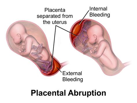 If I have bleeding during pregnancy, could this hurt my baby?