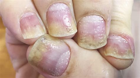 Nail psoriasis causes, symptoms, diagnosis, treatment & prognosis