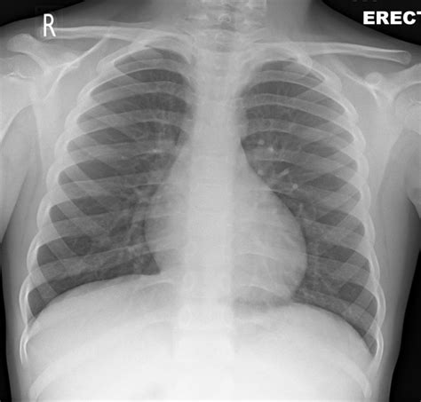 NORMAL CHEST XRAY | Buyxraysonline