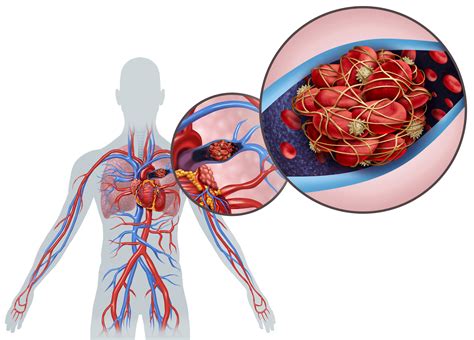 What Is a Pulmonary Embolism? | YourCareEverywhere