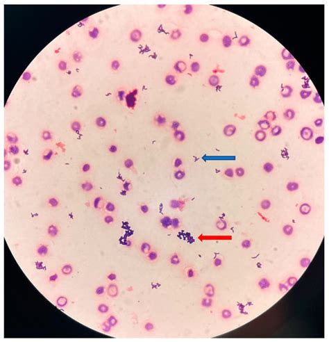 Microorganisms | Free Full-Text | Acute Pyelonephritis with Bacteremia ...