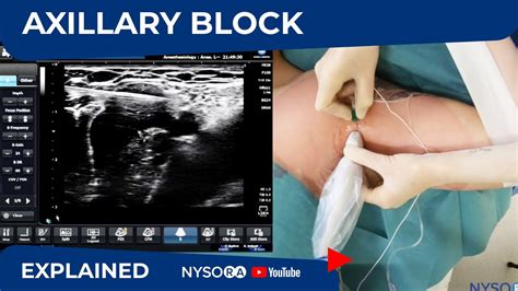 Ultrasound Guided Axillary Brachial Plexus Block NYSORA Regional Anesthesia - YouTube