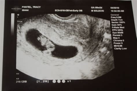 Baby ultrasound pics at 8 weeks Idea | hostalelportalico