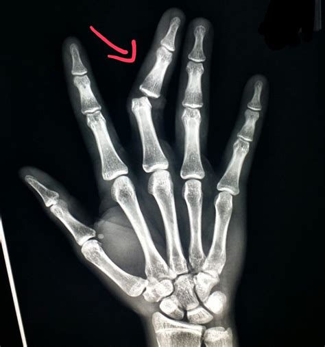 #Hand #xray shows a #dislocated #finger after a #karate #match. #radiologist #radiology #trauma ...