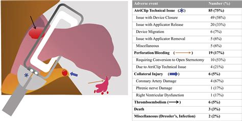 Adverse events associated with the AtriClip device for left atrial appendage occlusion: A Food ...