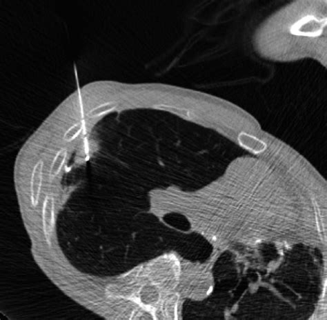 Under CT fluoroscopy guidance, the cryoprobe was inserted into the ...