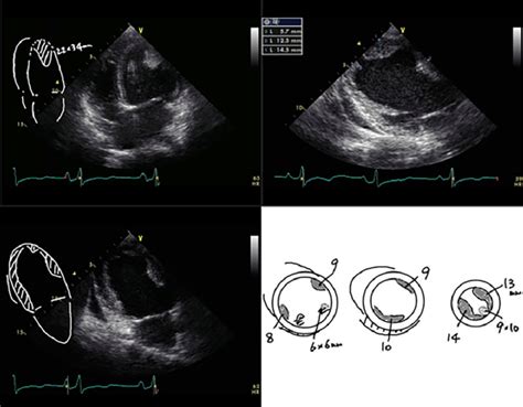 Left ventricular apical thrombus on echocardiography. | Download ...