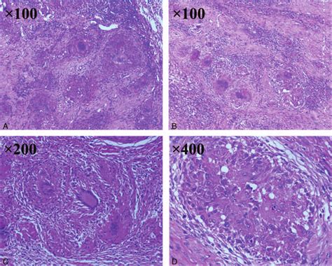 Histology of the pathological specimen reveals the presence of both ...