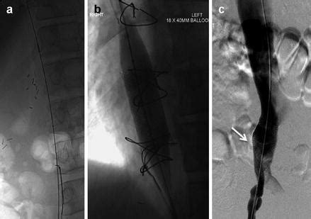 Migrated Superior Vena Cava Stent Repositioned Using a Balloon and Loop Snare Combination ...