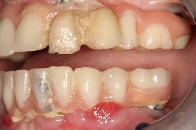 Dental Implant Complications - Peri-Implantitis