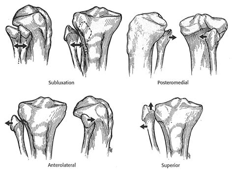 Proximal Tib-Fib Dislocation - Knee & Sports - Orthobullets