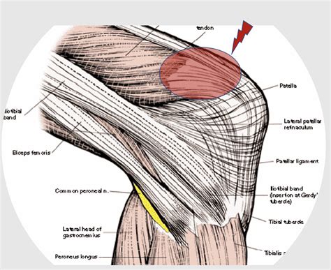 Quadriceps Tendonitis Causes Treatment Knee Pain Expl - vrogue.co