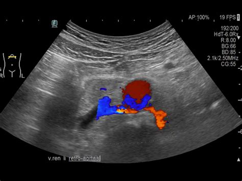 Retroaortic left renal vein ( RLRV) | Ultrasound Cases