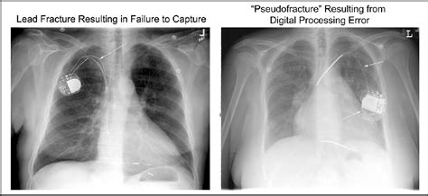 Figure 9 from Complications of Pacemaker Implantation | Semantic Scholar