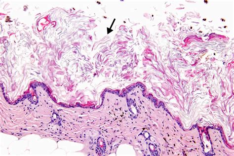 Hyperkeratosis definition, causes, prognosis & hyperkeratosis treatment