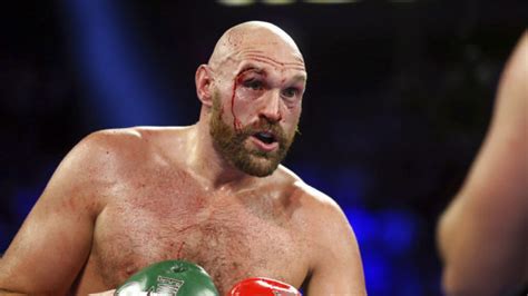 Bloodied but unbowed, Tyson Fury 'ready for war' against Deontay Wilder ...