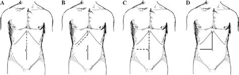 Experience with Reversed L-Shaped Incision for Right Hemicolectomy ...