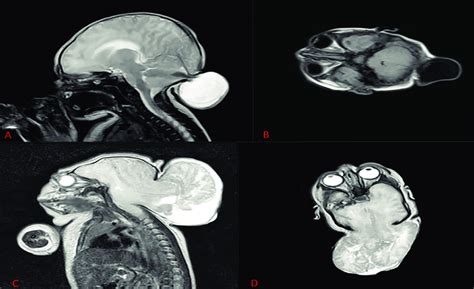 A, B, MRI sagittal and axial view of occipital meningocele. C, D, MRI ...