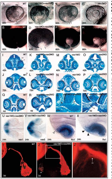 Choroidal fissure | Semantic Scholar