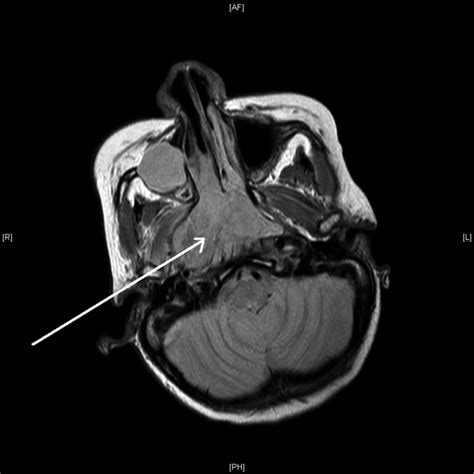 Axial MRI view showing an enhancing soft tissue mass lesion (indicated... | Download Scientific ...