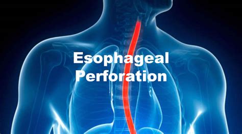 Esophageal tear causes, symptoms, diagnosis & treatment