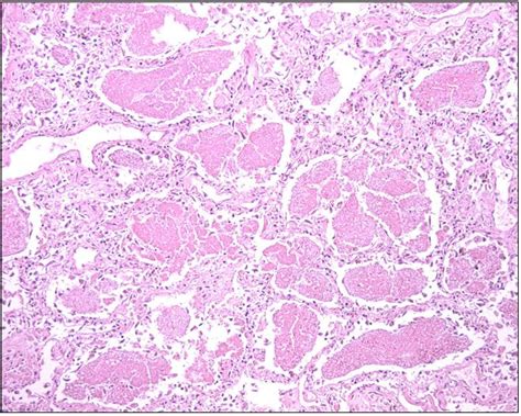 Alveolar proteinosis