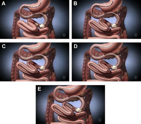 Schematic layout of mid-gut stent placement using double balloon... | Download Scientific Diagram