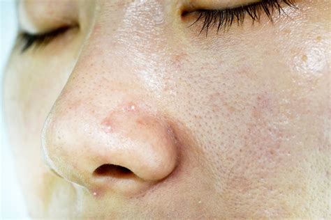 Whiteheads on Nose: Causes, and How to Get Rid of Them ASAP