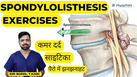 Spondylolisthesis Exercises | Spondylolisthesis physiotherapy treatment ...