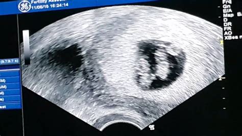 6 Week Ultrasound, its twins! - YouTube