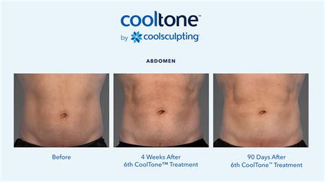 CoolTone® Scottsdale AZ | Muscle and Body Toning Treatments Phoenix