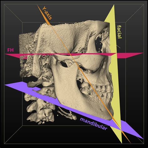 Influence of different setups of the Frankfort horizontal plane on 3 ...