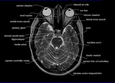 MRI anatomy brain axial image 9 | Brain anatomy, Mri brain, Anatomy