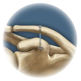 Acromioclavicular Joint Stabilisation-ACUTE | St. George's Shoulder Unit