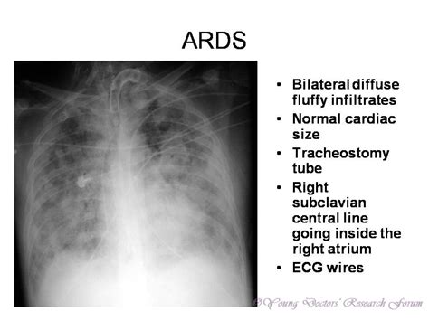 Identification of Chest X-rays of Common Lung Diseases ~ YOUNG DOCTORS' RESEARCH FORUM